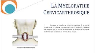 La Myélopathie Cervicathrosique Cervicarthrosis Myelopathy SFCR [upl. by Cyrie248]