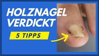 Holznagel verdickt 3 Tipps Nagel schmerzfrei bearbeiten [upl. by Green]