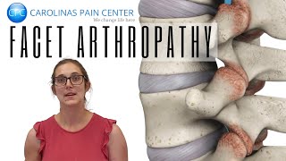 Natalie Explains Facet Arthropathy [upl. by Tori119]