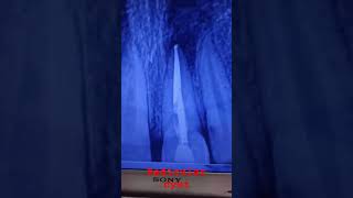 radicular cystviralshort shortvideo dentaltreatment periapical cystdentist [upl. by Lenoyl809]