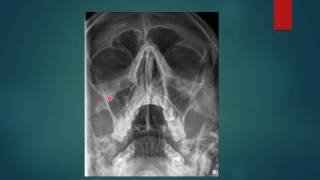 PARANASAL SINUSES RADIGRAPHY PNS X RAYS WATERS VIEW [upl. by Alathia302]