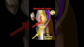 Fig 3A13 Stenerlike lesion of MCL avulsed distal MCL retracted medial to the pes tendons [upl. by Stodder]