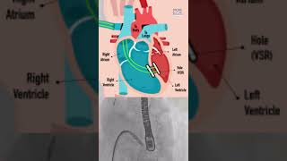 Ventricular Septal Rupture VSR  The Valve Clinic [upl. by Wallie]