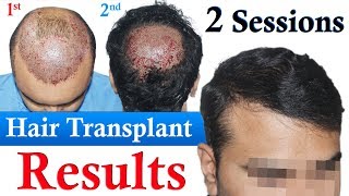 Hair Transplant with low Donor Dr Suneet Soni  Medispa India  Best Hair Transplant Jaipur Delhi [upl. by Atews]