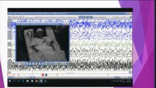 Video EEG en Epilepsia [upl. by Wallis]