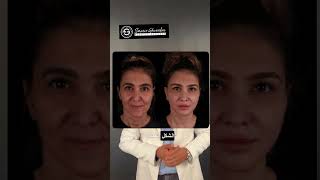 شد الشفايف العميق  Deep Plane Lip Lift ✨ drghoraba اكسبلور plasticsurgerydubai facelift [upl. by Philbrook]