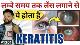 Keratitis Eye Infection Cause Symptoms amp Treatment In Hindi [upl. by Derej]