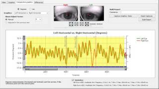 Pendular Nystagmus Gazelab [upl. by Coad]