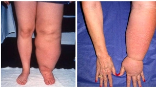 New Treatment Hope for Lymphedema Patients [upl. by Airbmak]