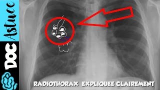 🔴 5 Dr Astuce  APPRENDS LE SYNDROME ALVEOLAIRE EN  DE 5 MIN  partie 1  Dr Astuce [upl. by Arracat]