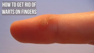 How to Get Rid of Warts on Fingers [upl. by Ainecey]