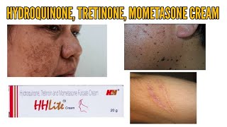 Hydroquinon tretinoin mometasone furoate cream  HH Lite Cream  Skinlite cream  No scar cream [upl. by Rattan]