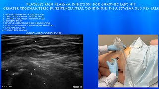 Ultrasound of Greater Trochanteric Bursitis Platelet Rich Plasma Injection in a 35 Year Old Female [upl. by Eward]