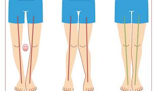 Dr Rozbruch discusses his approach to bowleg correction [upl. by Vicki20]