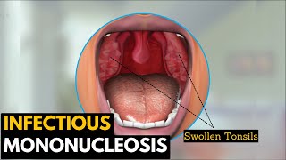 Infectious mononucleosis Causes Signs and Symptoms Diagnosis and Treatment [upl. by Underwood]