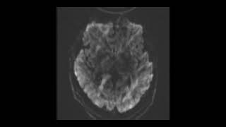 MRI BRAIN TBI Set 7 [upl. by Eimam883]