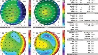 corneal topography galilei g 4 scan eye allergy test laser Urdu Hindi [upl. by Etteluap]