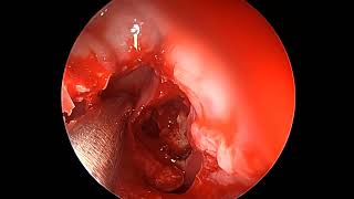 Endoscopic frontal sinusotomy [upl. by Nnyleve]