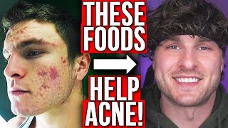 BEST FOODS TO GET RID OF ACNE FROM EXPERIENCE [upl. by Mloc]