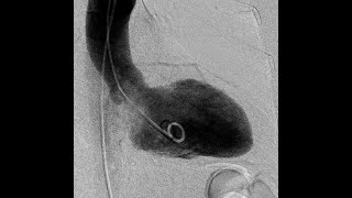 notes on LV angiography  IHD HCM Takotsubo and others [upl. by Sidoma]