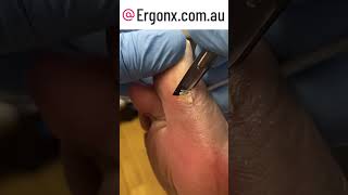 Big toe callus hard skin removal by podiatrist [upl. by Kolodgie]