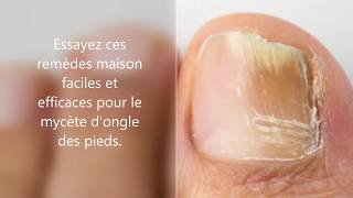 Comment jai soigné ma mycose des pieds facilement et naturellement  Allez Santé [upl. by Alarise]