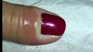 ONICOCRIPTOSE NA MĂO HAND ONYCHOCRYPTOSIS  PODĂ“LOGO MAURĂ‰LIO [upl. by Ybanrab]