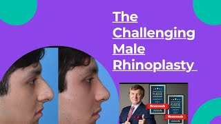 The Challenging Male Rhinoplasty [upl. by Elreath]