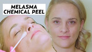 Jessner Peel An Effective Melasma Treatment  MAKEOVER [upl. by Pattin]