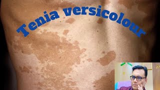 Tinea versicolour treatment Tinea versicolour causes fungal [upl. by Buffy]