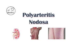 Polyarteritis Nodosa PAN  Signs amp Symptoms Diagnosis Treatment [upl. by Yttam]