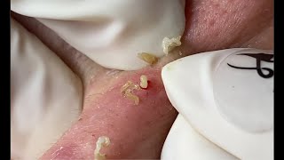 Acne Treatment Huong Da Nang  590 [upl. by Macrae810]