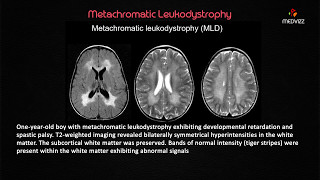 Metachromatic Leukodystrophy  USMLE Biochemistry webinar Case based lecture [upl. by Meri]