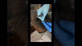 Dandruff Removal 4 dandruffscratching psoriasis shorts shortsvideo scratching scalp [upl. by Enilesor]