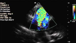 Patent Ductus Arteriosus in a dog [upl. by Bax]