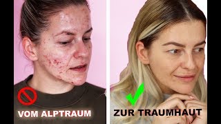 ❗️ In NUR 3 Monaten zur TRAUMHAUT  HEFTIGES Ergebnis ❗️ Microneedling Vorher Nachher Diana Delo [upl. by Ott]