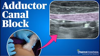 Adductor Canal Block 2024 update [upl. by Mchale490]