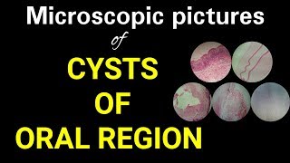 Microscopic pictures of cysts of oral region microscopic pictures of oral pathology Dr Poojireddy [upl. by Nered]