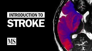 Introduction To Stroke [upl. by Rramel316]