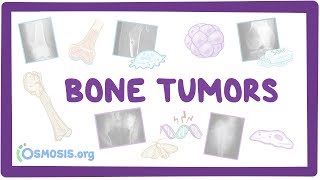 Bone tumors  causes symptoms diagnosis treatment pathology [upl. by Ennayhc653]