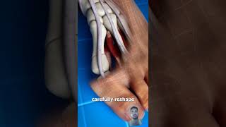 Bunion Correction 😨 explained shorts animation usa canada australia [upl. by Eelarbed]