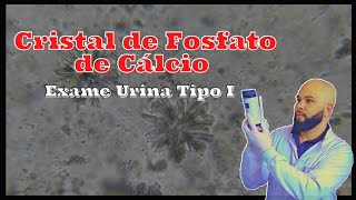 Cristais de Fosfato de Cálcio na Urina  EAS  Rotina Laboratórial [upl. by Hpsoj13]