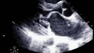 Mitral Stenosis  Echo Clip [upl. by Lemire750]