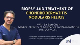 Biopsy and Treatment of Chondrodermatitis Nodularis Helicis [upl. by Josefina]