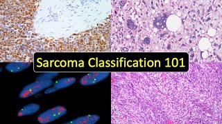 Sarcoma Classification 101 Soft Tissue Tumor Naming Made Simple for Beginners amp NonPathologists [upl. by Allimrac]