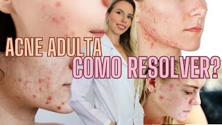 ACNE ADULTA COMO TRATAR   Bruna Harmel [upl. by Neirrad]