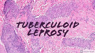 Tuberculoid Leprosy Hansen disease 5Minute Pathology Pearls Dermatology Dermatopathology [upl. by Ut]