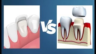 Veneers vs Crowns  Whats the Difference [upl. by Schoenberg563]