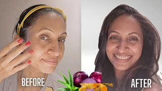 How to remove PIGMENTATION from Face Naturally AT HOME  झाइयां हटाने के नुस्खे [upl. by Larcher]