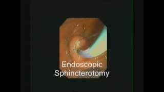 ERCP  Large Sphincterotomy for Large Stones  STEFANOS DOKAS  The ERCP Channel [upl. by Einor]